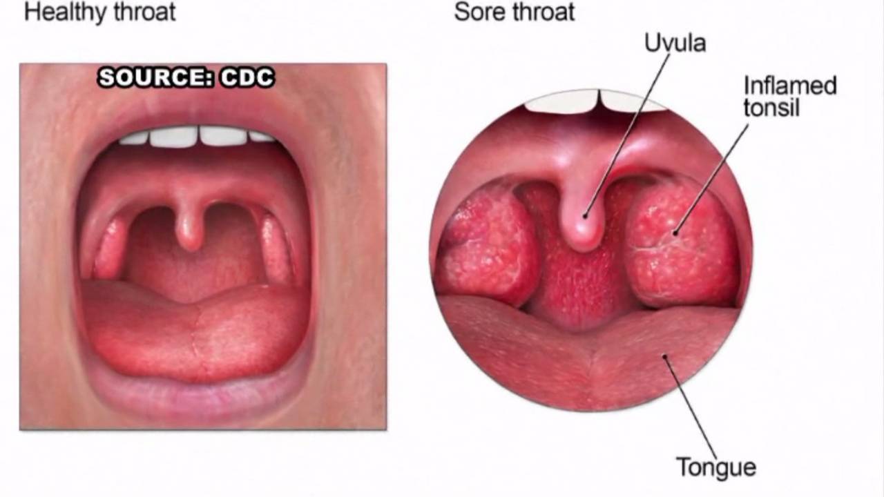 Strep throat in adults without fever