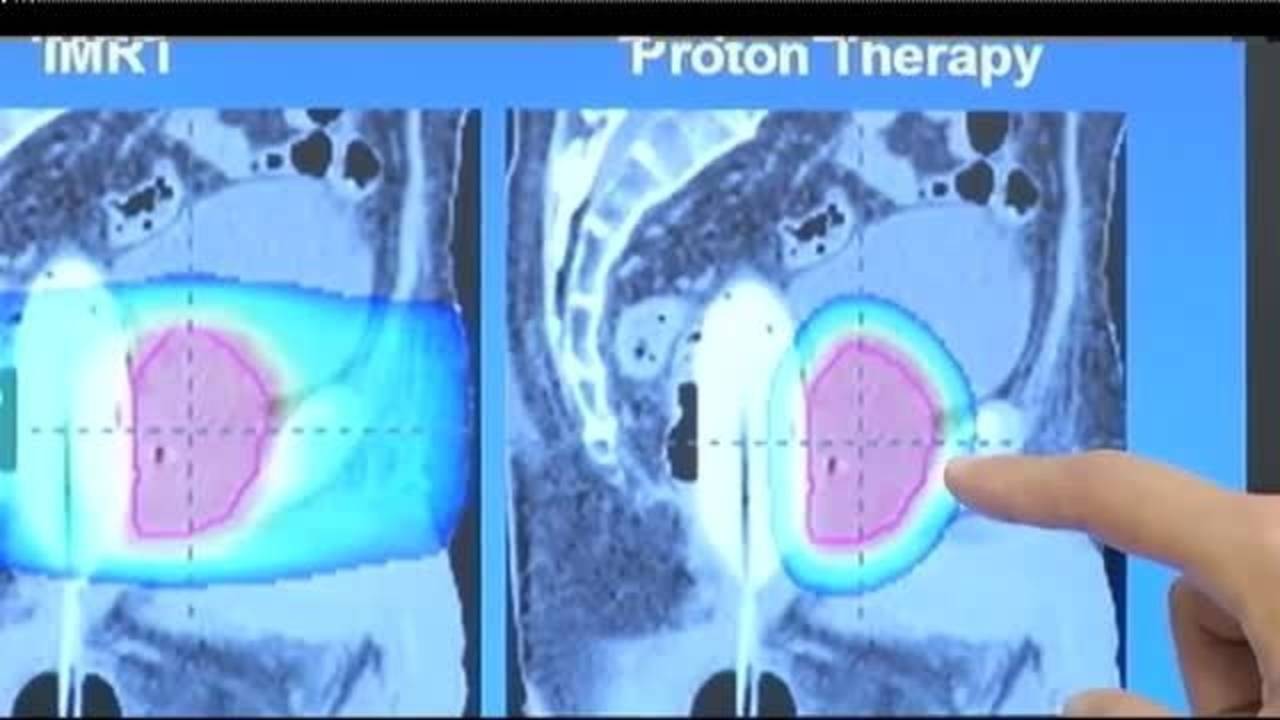 Proton Therapy Helps Patient Beat Prostate Cancer 4932