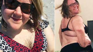 Woman With Excessive Hair Growth On Her Face Chest And Back