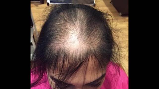 Image result for thinning hair