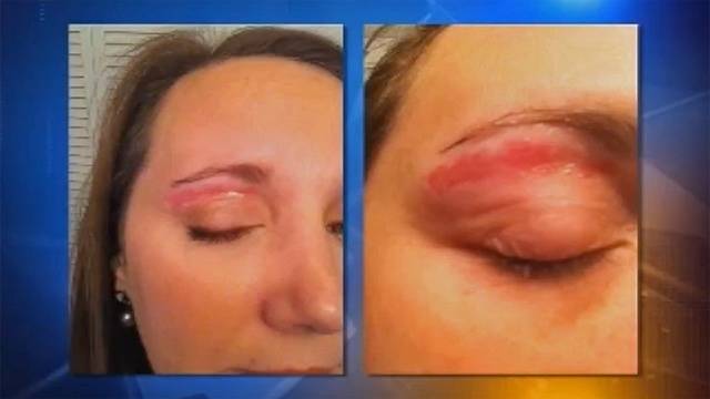 Billig roaccutane